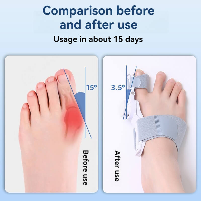 Tawazun™（Hallux valgus corrector）